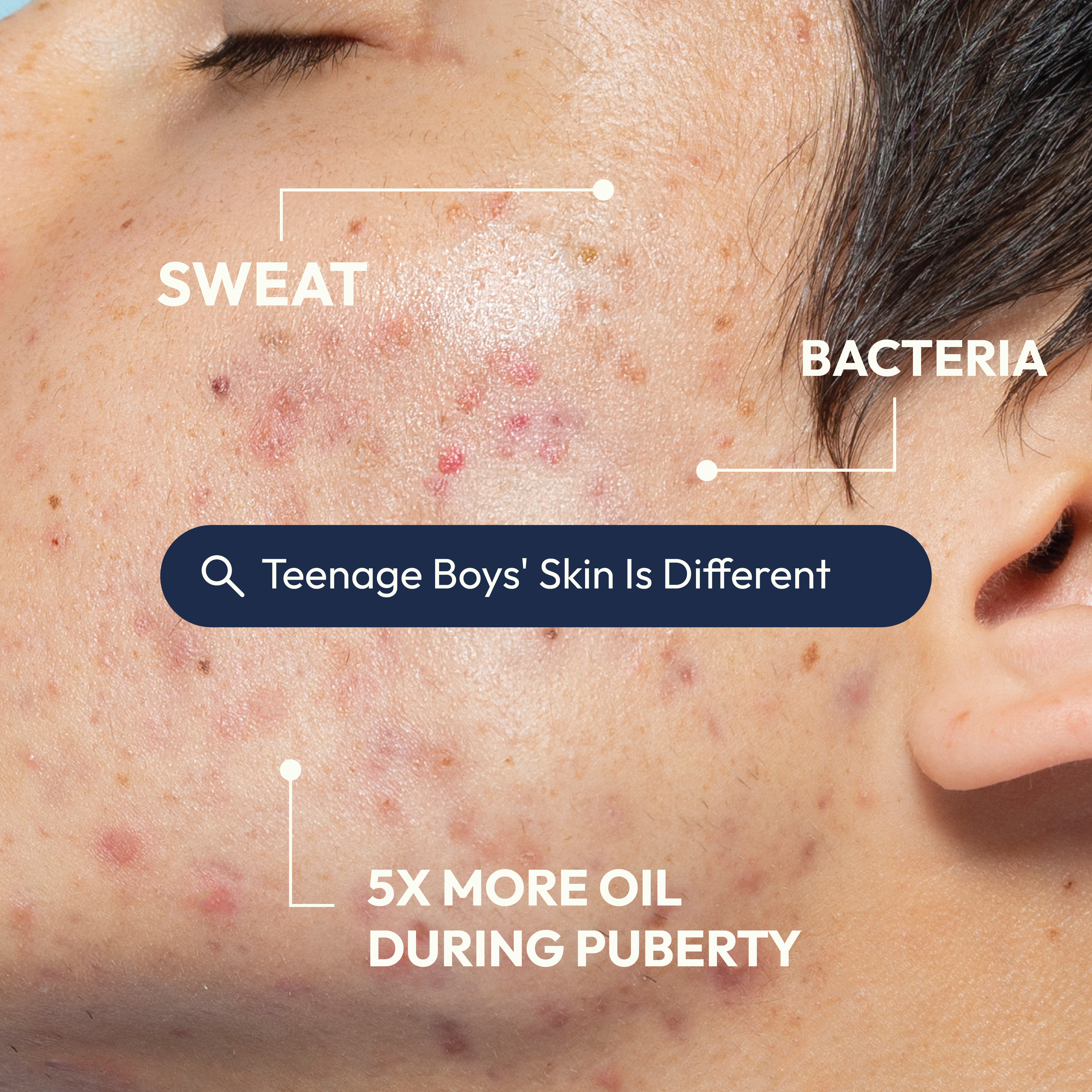 Teenage Boys’ Skin is Different